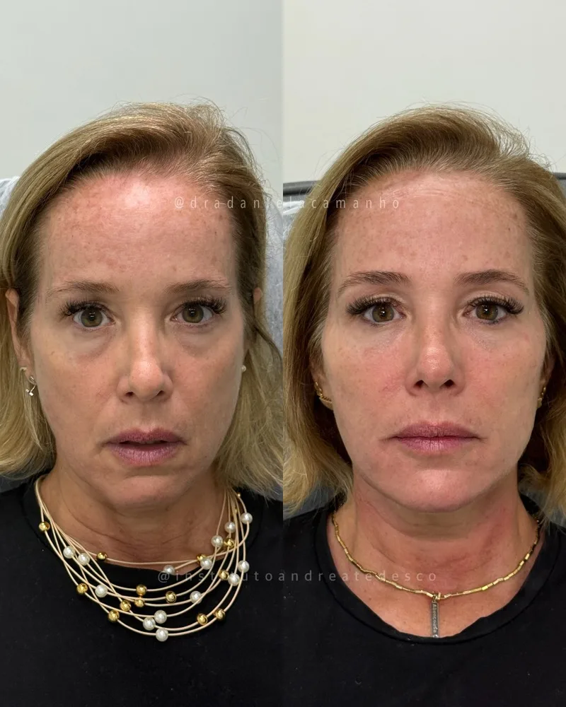 Antes e depois: Harmonização do terço médio e inferior — vista frontal