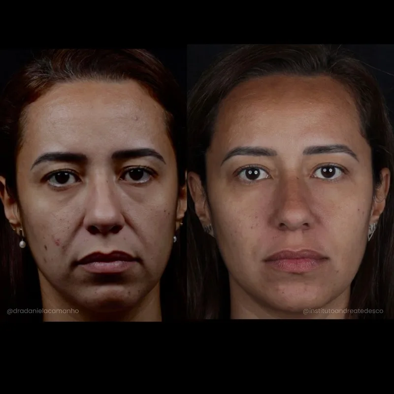 Antes e depois: Harmonização facial completa — equilíbrio e naturalidade
